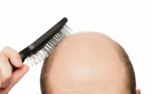 La consommation excessive de boissons sucrées serait l’une des causes de la calvitie 