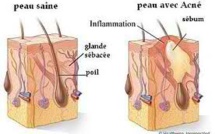 L’acné est causée par une surproduction de sébum. Mais qu'est-ce que le sébum ?