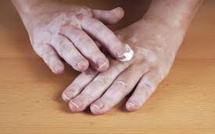 Enfin un traitement contre le vitiligo : la maladie des taches blanches sur la peau