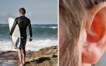 Exostose : Comprendre la maladie des surfeurs