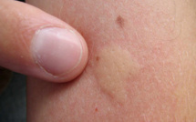 Nos amis les insectes sont parmi nous : que faire en cas de piqûre ?