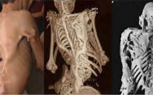 Patient bizarre : la maladie qui transforme les muscles en « pierre »