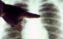 La tuberculose est encore persistante au Maroc