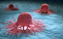 Cancer : l'OMS alerte sur une explosion des cas à l'horizon 2050