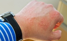 L'Urticaire : Approches Traditionnelles et Naturelles