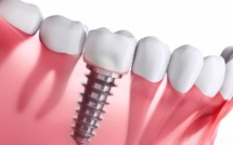 Les dernières innovations en implantologie dentaire