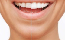 Les traitements esthétiques dentaires