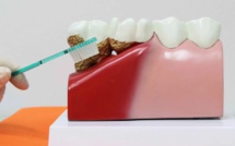 La prévention et le traitement des maladies parodontales