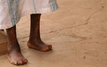 La lèpre persiste au Maroc : 14 nouveaux cas détectés