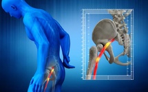 Entretien : La sciatique expliquée par un rhumatologue