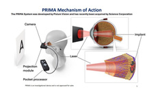 « Rendre la vue » n’est plus un rêve : l’implant rétinien qui redonne une vision centrale aux patients DMLA