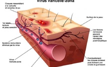 Le Zona : quand un virus endormi se réveille et transforme le corps en champ de bataille