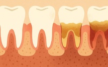 La Parodontite : une maladie silencieuse qui détruit les dents… 