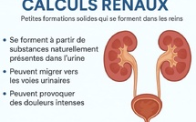 Calculs rénaux : comprendre ces petits cristaux qui peuvent provoquer de grandes douleurs.