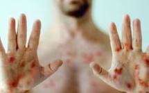 Mpox à New York : un seul cas, mais un signal que la santé publique ne peut pas traiter à la légère