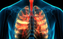 Tuberculose extra-pulmonaire : alerte au Maroc