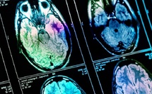 Une glycémie élevée pourrait accélérer le vieillissement du cerveau, selon une étude